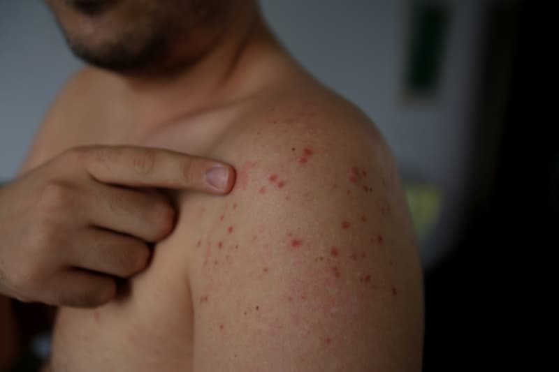Measles Surge Kills 5 Across Pennsylvania